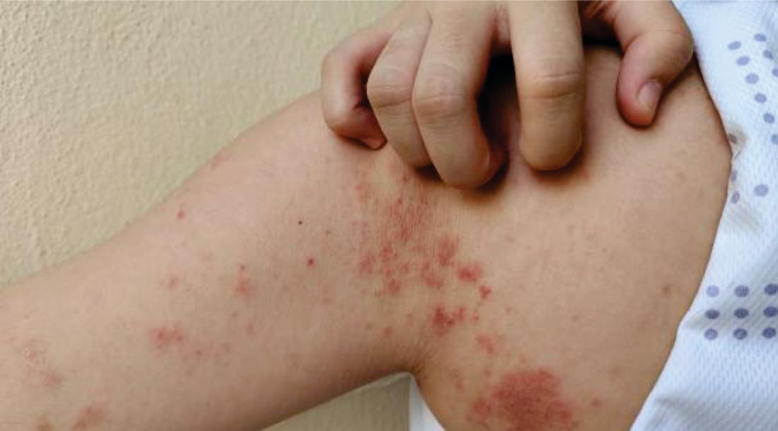 Dermatologista do Ipesaúde destaca importância do diagnóstico precoce da hanseníase